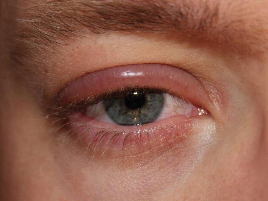 17 عارضه که سلامت چشم را تهدید می کند